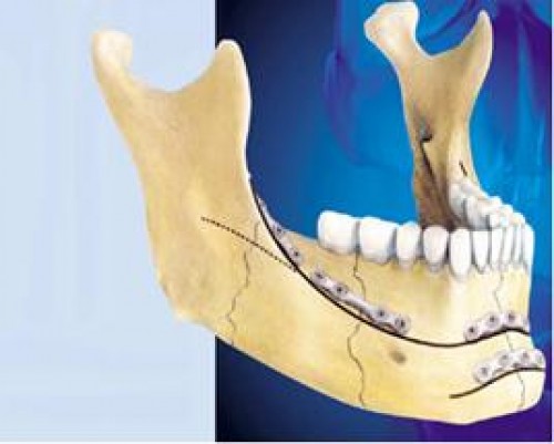 Accesul endooral şi cel exooral în osteosinteza mandibulei. Indicaţii şi contraindicaţii. Avantaje şi dezavantaje (Recomandare metodică)