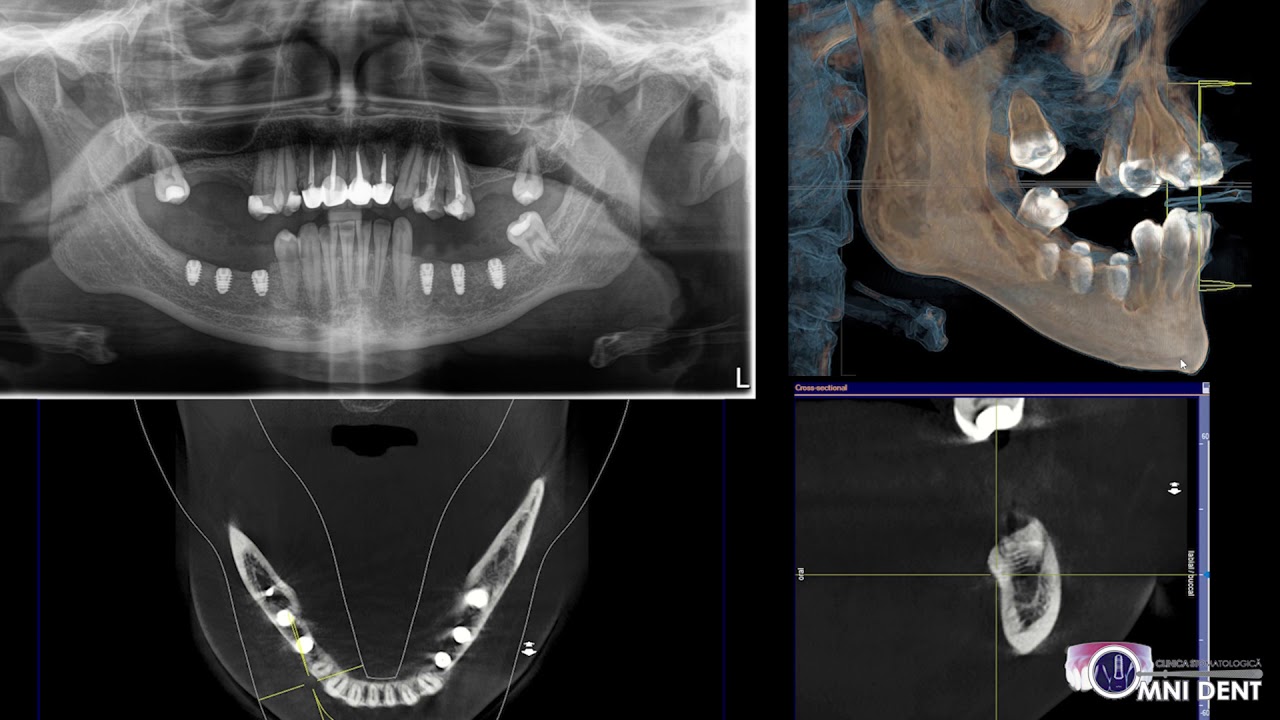 Reabilitarea pacientului cu atrofie severă în regiunea posterioară a clasei mandibulei C-h Mich