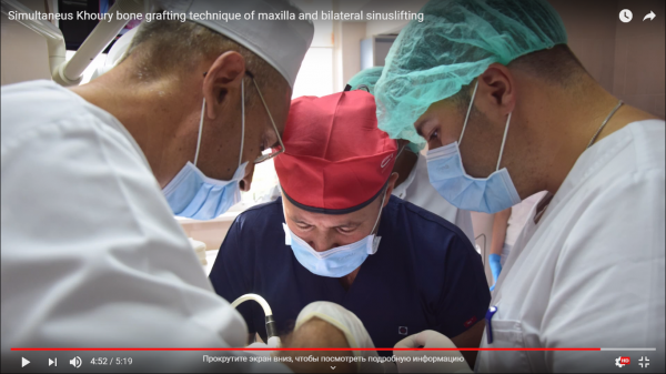 Simultaneus Khoury bone grafting technique of maxilla and bilateral sinuslifting