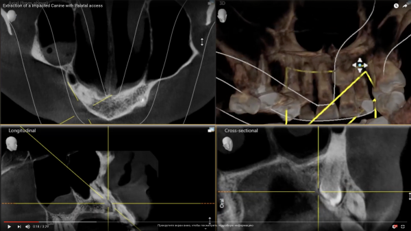 Extraction of a Impacted Canine with Palatal access