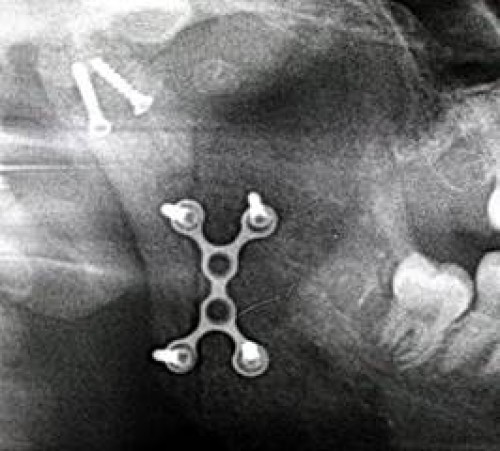 Rezultatele tratamentului chirurgical al fracturilor de condil mandibular în dinamică