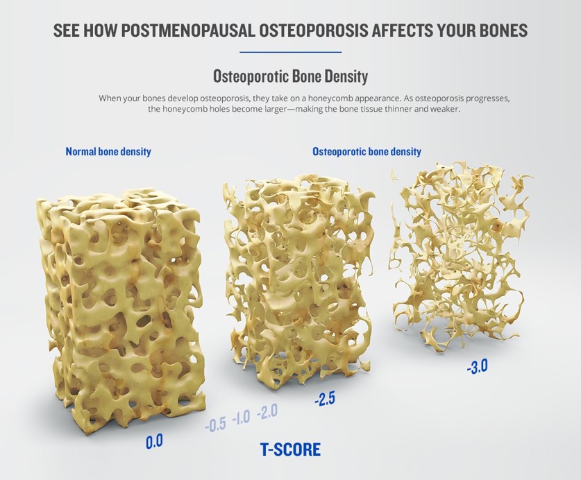 Efectele osteoporozei asupra danturii 